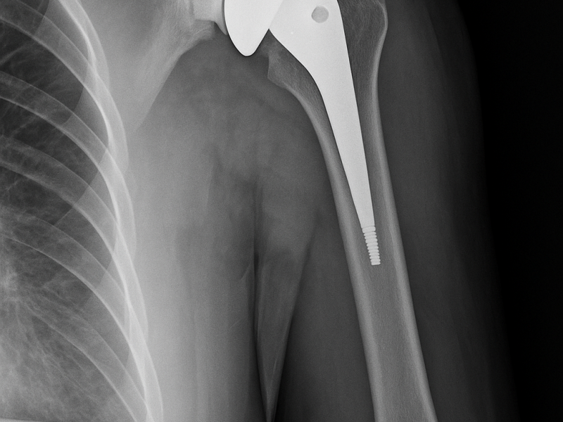20250628_1458_Shoulder X-Ray_simple_compose_01jyv2y2s0e8t87901cs7c433d