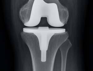 20250709_1709_X-Ray Knee Replacement_simple_compose_01jzqms6ydep3bwt240stqt1e4