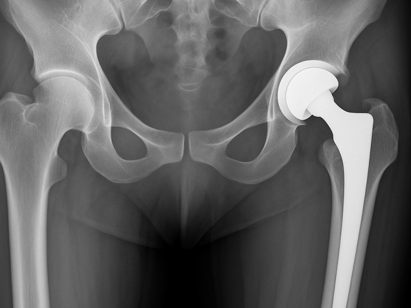 20250709_1710_X-Ray Hip Replacement_simple_compose_01jzqmvtrgfafbcv12cjvr8ef8