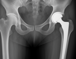 20250709_1710_X-Ray Hip Replacement_simple_compose_01jzqmvtrgfafbcv12cjvr8ef8