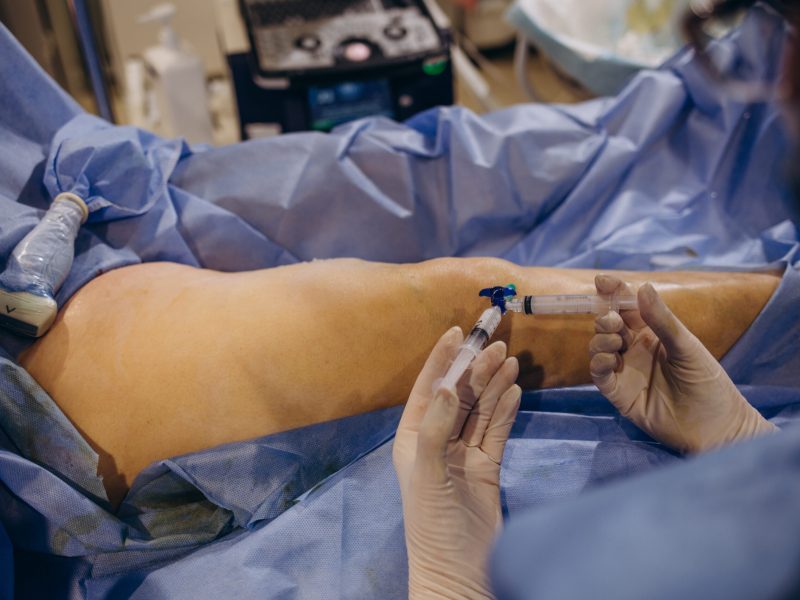 EVLT endovenous laser treatment to treat varicose veins