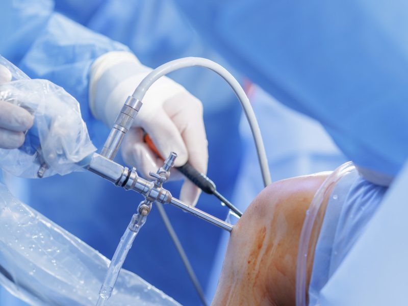 Close view of knee arthroscopy with PCL reconstruction showing arthroscope and cannulas on blue sterile drapes minimally invasive orthopedic surgery